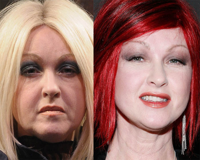 What Disease Does Cyndi Lauper Have Celebrity Exclusive