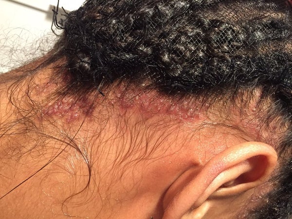 Does crochet cause breakage? (Celebrity Exclusive)