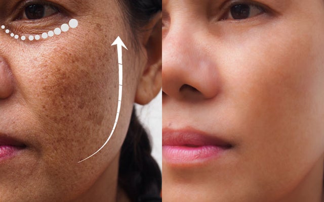 Is kojic acid good for hyperpigmentation? (Celebrity Exclusive)